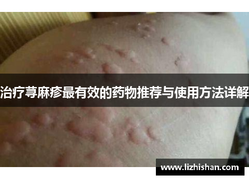 治疗荨麻疹最有效的药物推荐与使用方法详解