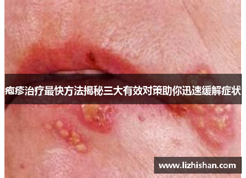 疱疹治疗最快方法揭秘三大有效对策助你迅速缓解症状