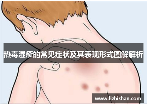热毒湿疹的常见症状及其表现形式图解解析 热毒湿疹的常见症状及其表现形式图解解析